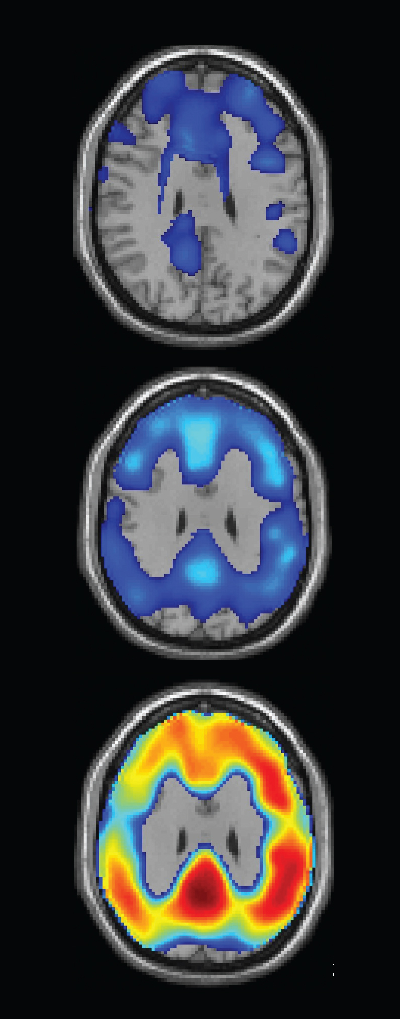 Biopharmaceuticals Inc. Clinical Study Alzheimer's Beta Amyloig