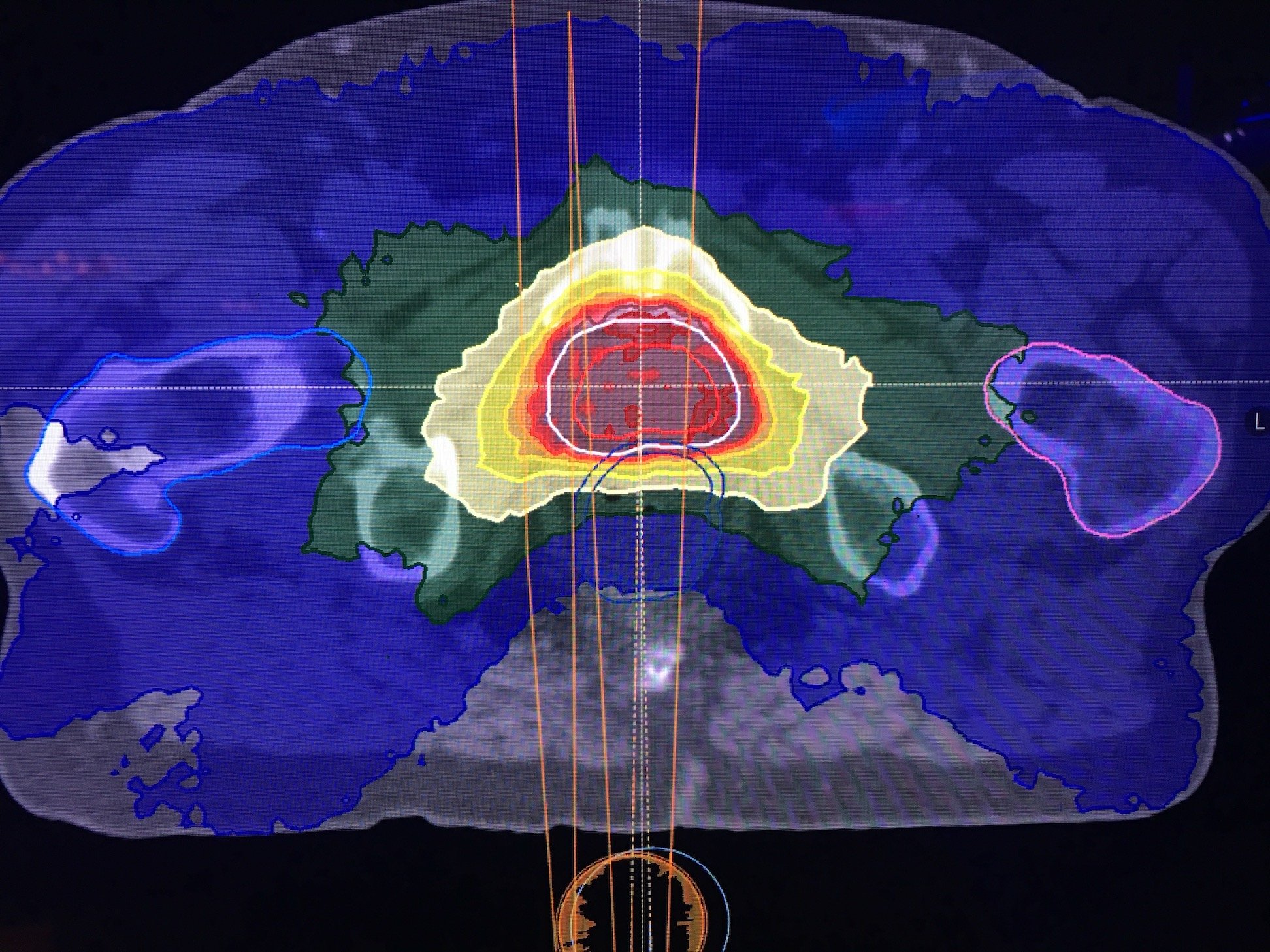 Artificial intelligence was by far the hottest topic in both radiology and radiation oncology in 2019, and AI is the subject of 8 of the top 2019 ITN videos. This image is a prostate treatment plan created autonomously by an AI algorithm from RaySearch and is the subject of the No. 2 video on the list. Deep learning in radiology and radiation oncology.