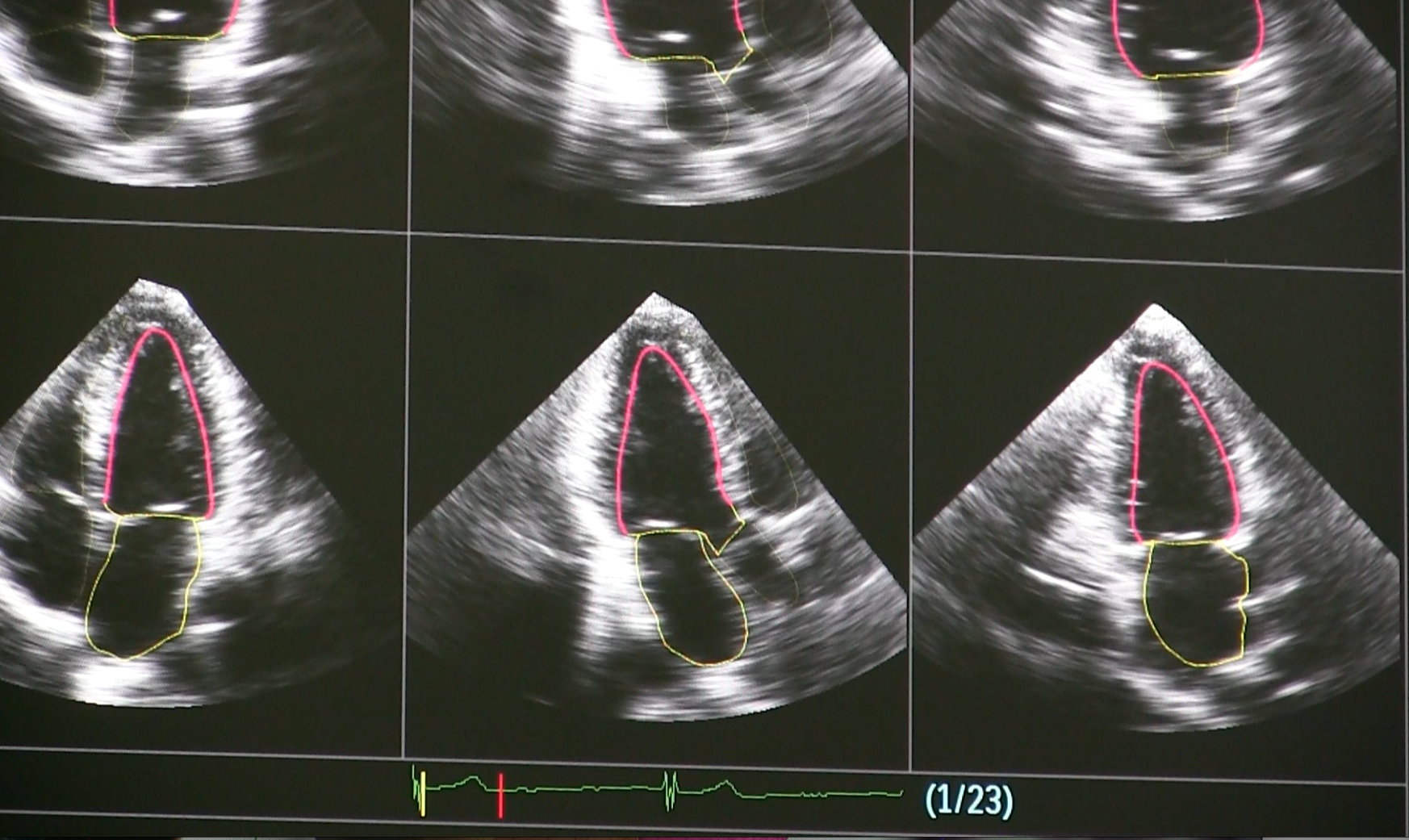 Philips Epiq Ultrasound uses artificial intelligence to automate standard echo views.