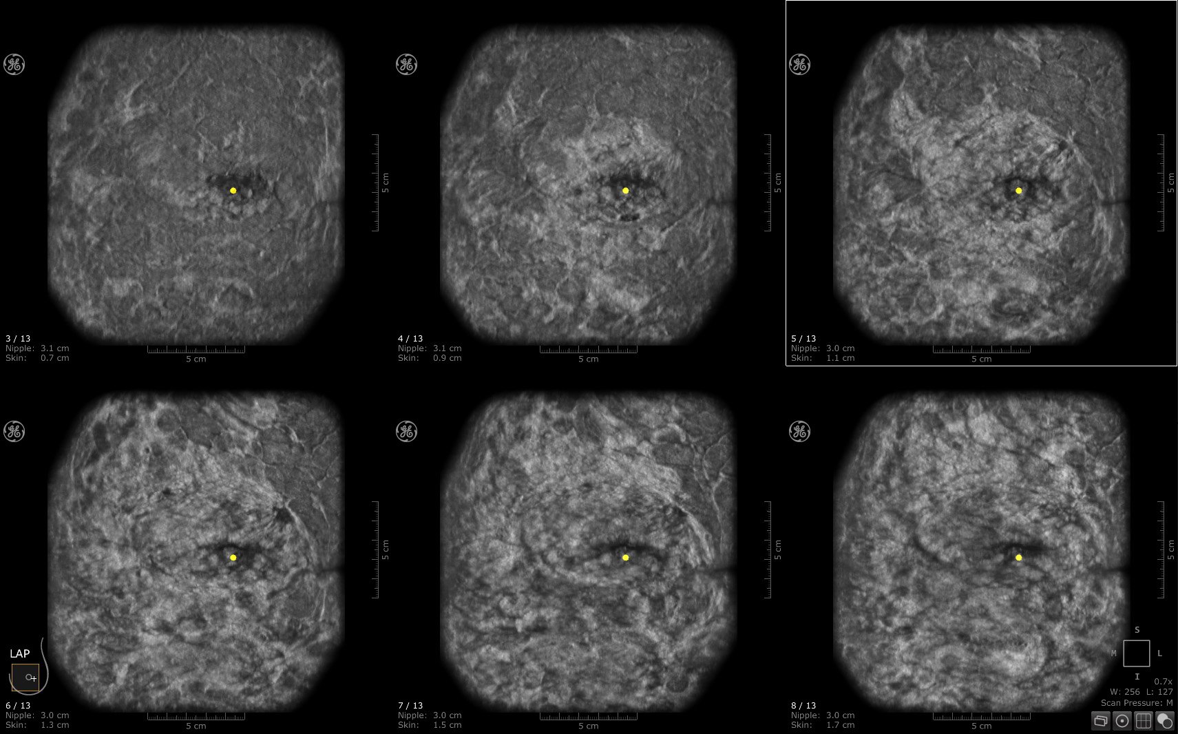 The benefits of adding whole breast automated ultrasound (ABUS) screening to clinical practice, enhancing cancer detection in the setting of dense breast tissue