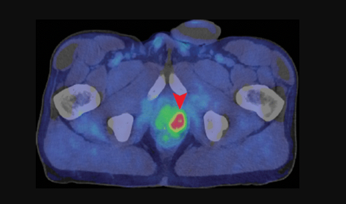 Axial fused PET/CT image shows intense uptake (arrowhead) in the deep pelvis corresponding to the left lobe of the prostate in a 62-year-old with a history of prostate cancer treated with radiation therapy.  The CT scan does not show the tumor. Image courtesy of the the Radiological Society of North America.