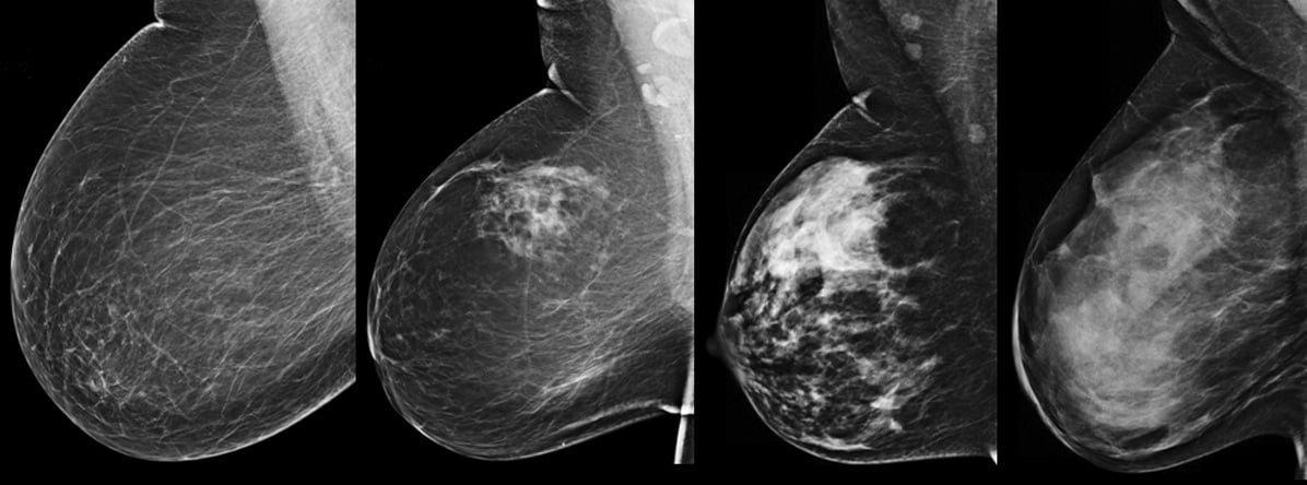 dense breast tissue, breast density imaging, BIRADS, BI-RADS, mammography grading system, comparison of dense breast tissue, Fibroglandular densities