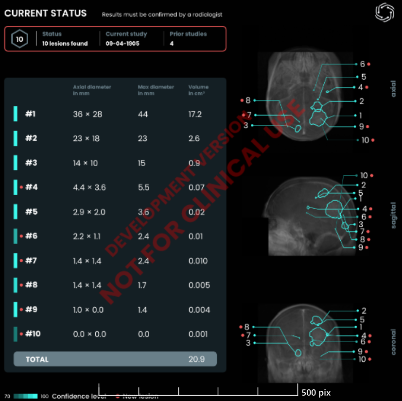 Using AI to Detect Tiny Brain Metastases