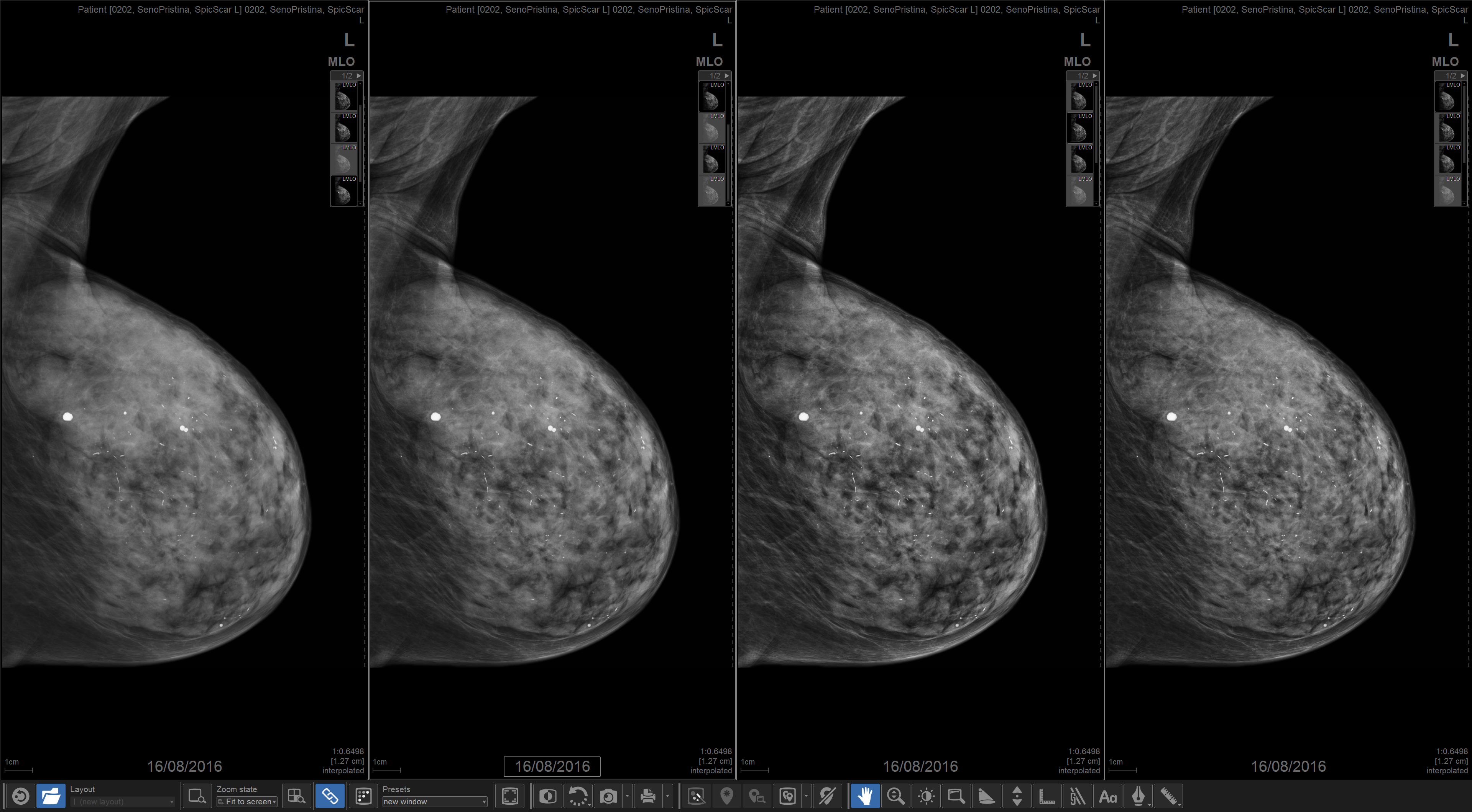 Another benefit of tomosynthesis is reducing patients’ radiation exposure, which is especially important if they need additional testing.