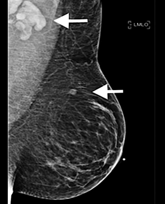A 37-year-old woman developed a new, palpable left supraclavicular lymphadenopathy lump five days after her first dose of the Moderna COVID-19 vaccine in the left arm. On the day of vaccination, the patient was asymptomatic. This is an example of how the vaccine can mimic cancer and swollen lymph nodes. Read more about this case study. Image used with permission of RSNA.