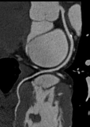 CTA, CCTA, CT angiography