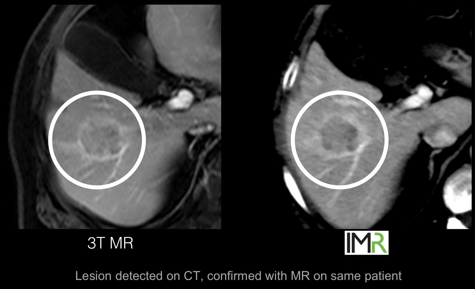 Philips' has developed the IMR CT spectral imaging software, which may offer detailed soft tissue imaging comparable to MRI, as shown here in a comparison of a imaging of the same soft tissue lesion.