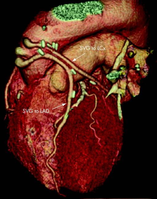 ct systems angiography clinical trial study CTA 320 anio core