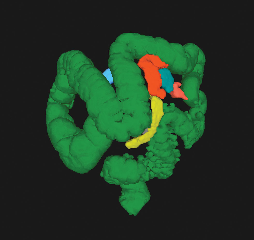 CT colonography (CTC) allows visualization of the entire colon in one image