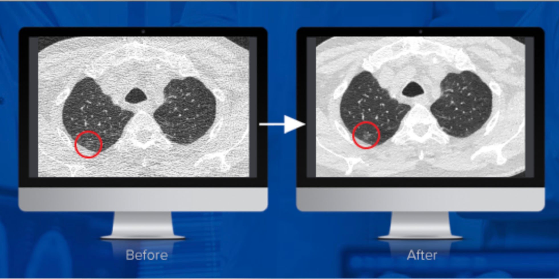 Studies conducted by Mass General Hospital and University of Virginia have concluded that PixelShine, a disruptive technology from AlgoMedica, significantly improved the diagnostic quality of CT scans acquired at reduced radiation dose. Here, you can see before and after noise reduction is applied.