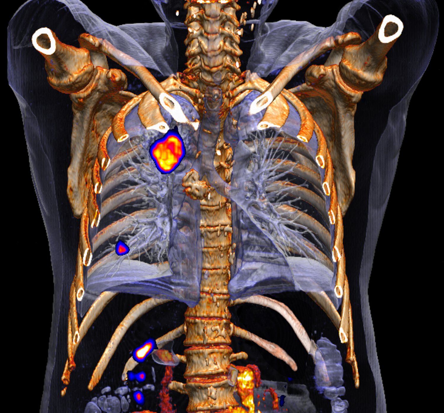 ASTRO Issues Guideline for Stereotactic Radiation Use in Early-Stage Lung Cancer