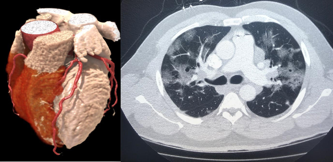 Left, a 3-D rendering of a heart from a cardiac CT exam. Right, a lung-CT exam showing the heart and ground glass lesions in the lungs of a COVID-19 patient. CT has become a front-line imaging modality in the COVID era because it offers both cardiac and lung information to help determine a patients disposition with chest pain, COVID-19 and COVID-caused myocarditis and pulmonary embolism. #COVID19 #CCTfirst #YesCCT