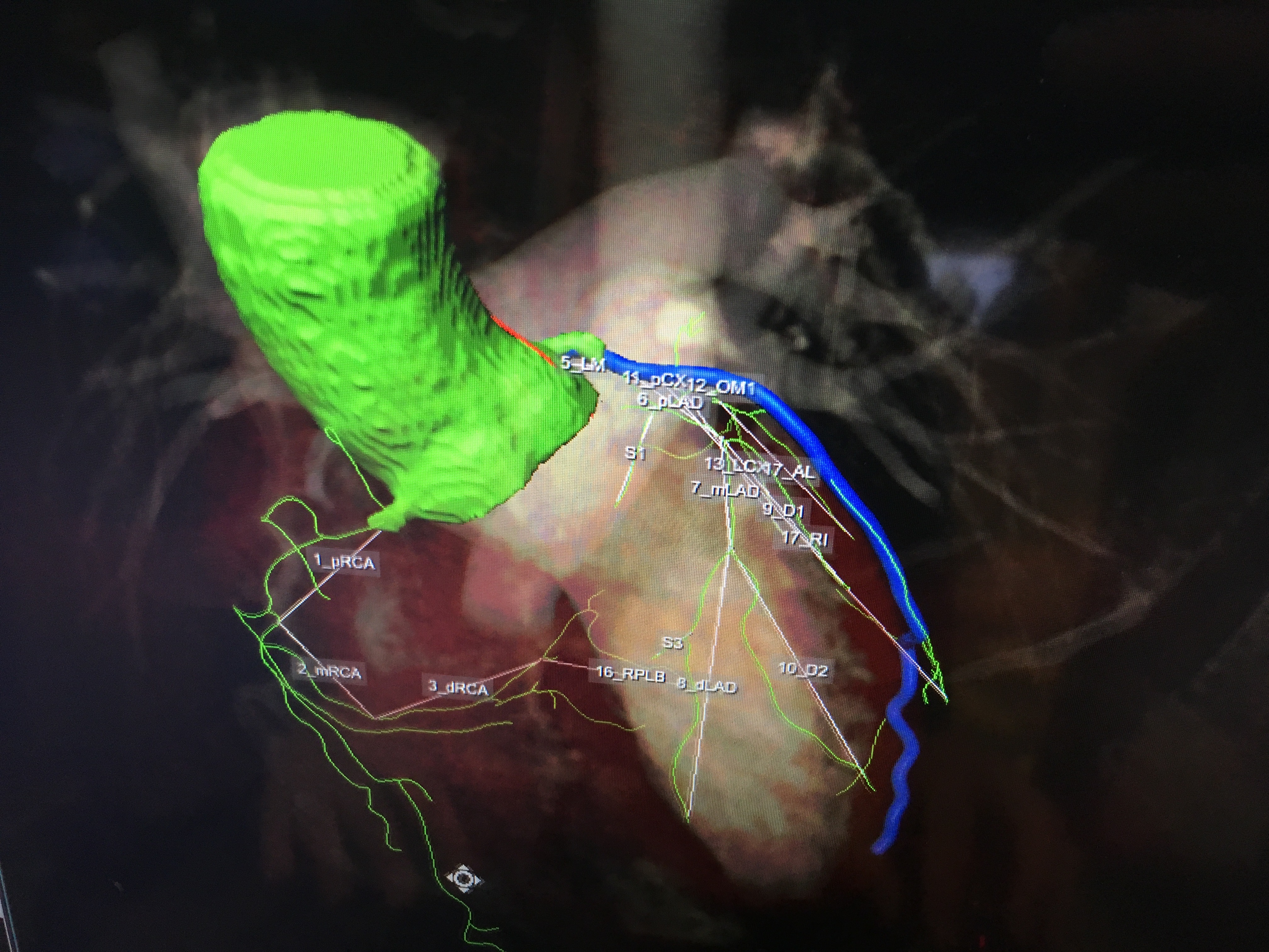 An example of the newest generation of smart cardiac CT software that automatically identifies the anatomy, autotraces the centerlines on the entire coronary tree and labels each vessel segment.