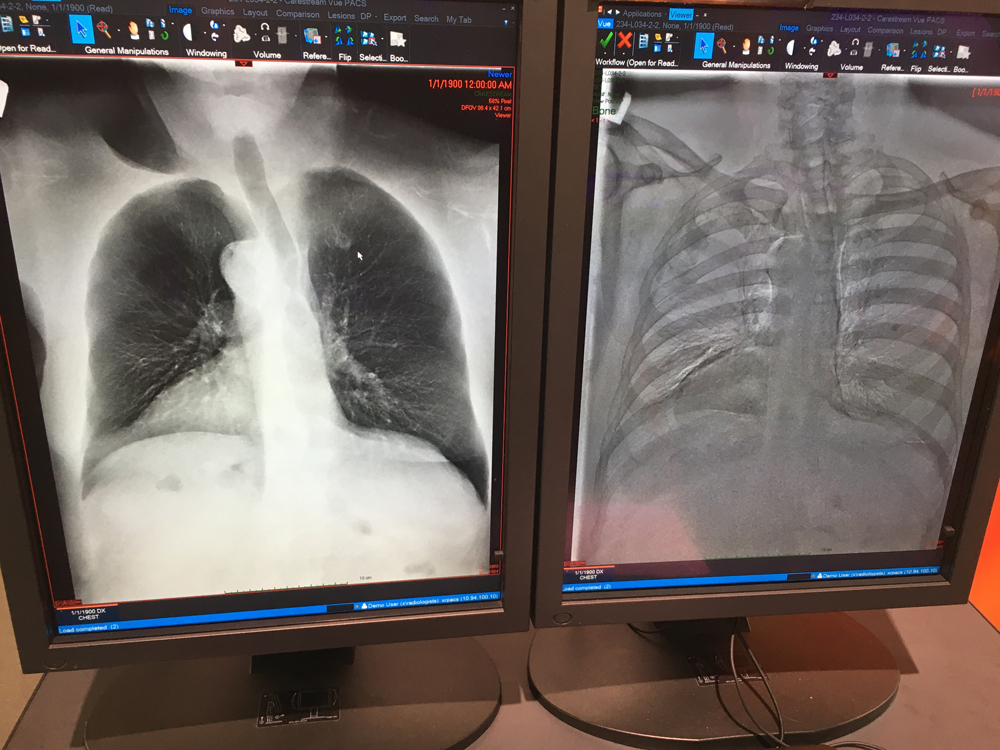 Carestream's new dual-energy X-ray imaging for its room install digital radiography (DR) system. Using software, the system can show a standard DR X-ray, a bone subtraction view and high and low Kv energy images, which bring out different sets of details in the image. The idea is to offer more diagnostic information from a single exam. The FDA cleared product allows low and high energy images to be created from a conventional DR X-ray using the vendor’s ImageView software.