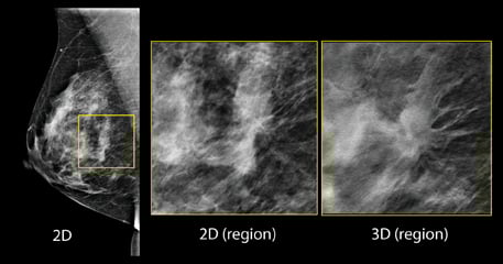 Advocating Breast Density Imaging Technology News Advocating Breast Density Imaging Technology News