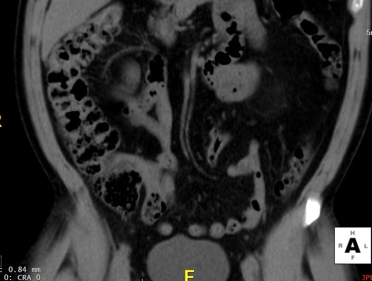 Normal colon with CT scan
