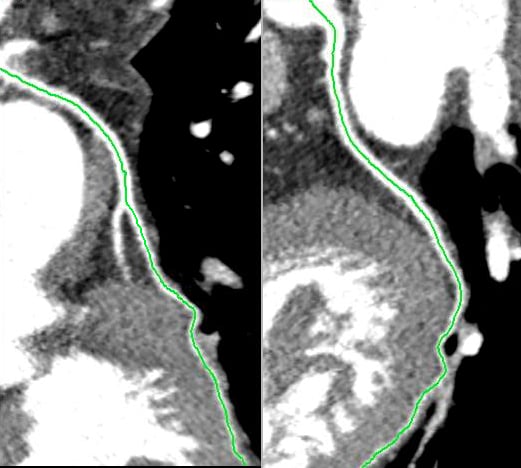 Computed tomography, coronary CT angiography, PROMISE trial, ACC