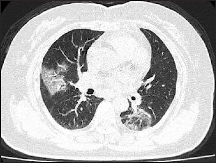 A chest CT scan of a 79-year-old woman who presented with fever, dry cough, and chest pain for three days. Her husband and daughter-in-law had been recently diagnosed with coronavirus disease. The patient expired 11 days after admission.(Courtesy of Song F, Shanghai Public Health Clinical Center, Shanghai, China) #COVID2019 #COVID19 #coronavirus #2019nCoV