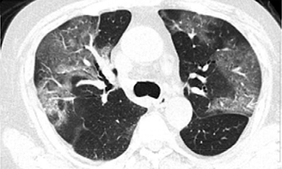 CT image of Novel Coronavirus 2019-nCoV from the Radiology article showing a baseline CT image of a 75 year old male with multiple patchy areas of pure ground glass opacity (GGO) and GGO with reticular and/or interlobular septal thickening. Follow-up CT images on day 3 after admission show an overlap of organizing pneumonia with diffuse alveolar damage in that it is more diffuse and associated with underlying reticulation. Read more and see 15 more images from novel coronavirus patients in the article.