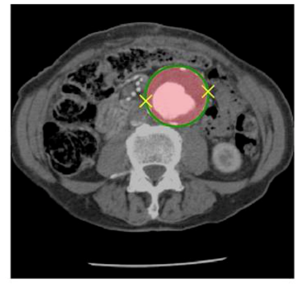 The DeepAAA algorithm, developed at the MGH & BWH Center for Clinical Data Science, accurately detected and measured an abdominal aortic aneurysm (AAA) in a CT image even though appearance of the AAA was complicated by a blood clot