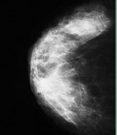 dense breast inform, dense breasts