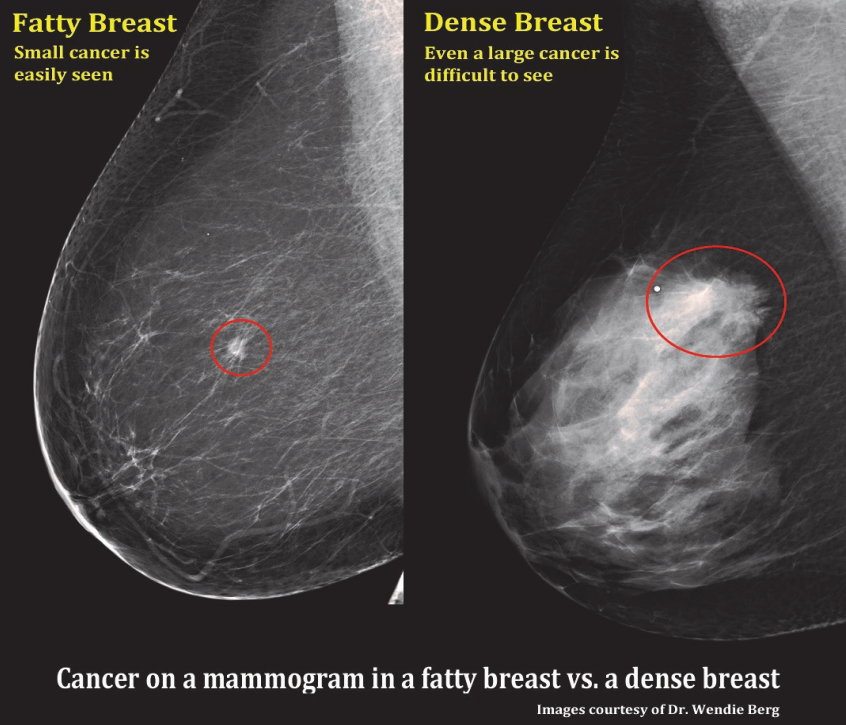 A comparision of a small breast cancer found in a patient without dense breast tissue (left), and a tumor found in a woman with dense fibroglandular tissue. Fibroglandular Dense Breast tissue Comparison 