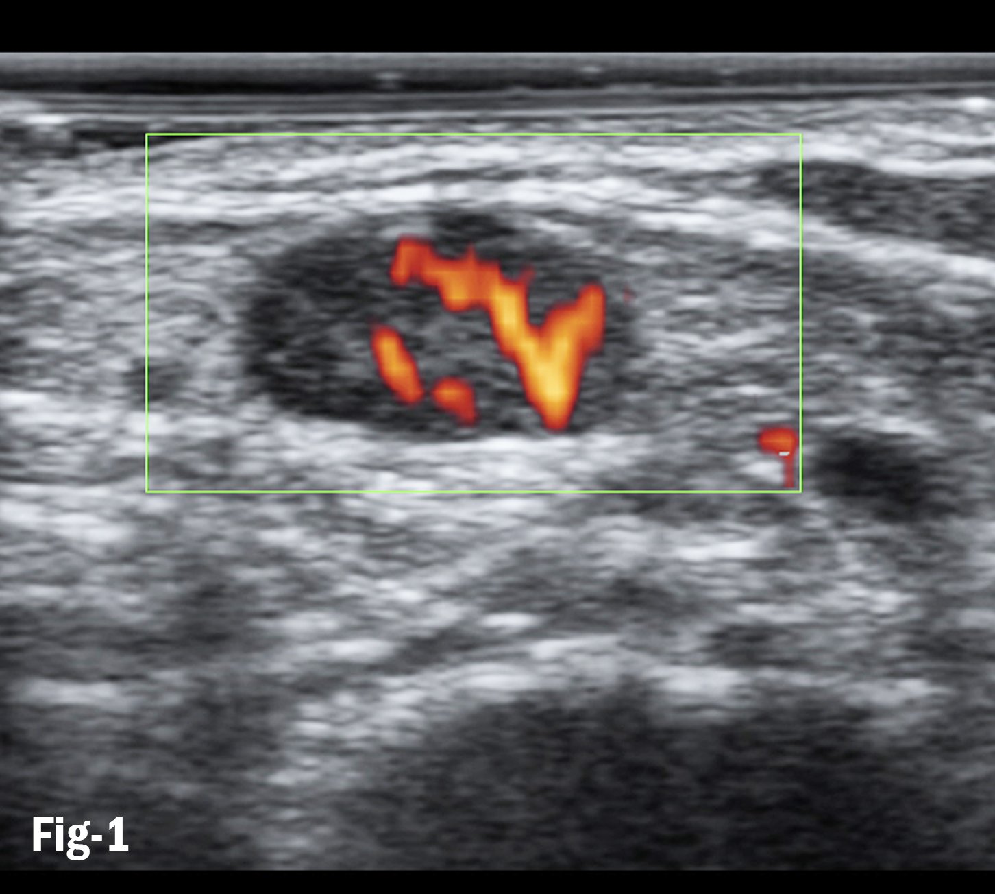 Figure 1. Doppler flows in subpleural consolidation shows smoothly dilated branching arteries