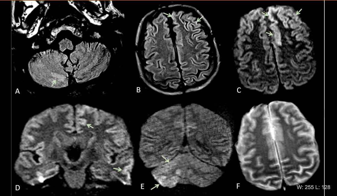 This is Figure 2 from the article in Radiology: Acute encephalopathy. A 60 year-old-man without history of seizures presenting with convulsion. (A-B) Multifocal areas of FLAIR hyperintensity in the right cerebellum (arrows in A), left anterior cingular cortex and superior frontal gyrus (arrows in B). (C-D) Restricted diffusion in the left anterior cingulate cortex, superior frontal and middle temporal gyrus (arrows in D) and right cerebellum (arrows in E), consistent with cerebellar diaschisis. F)  #COVID19