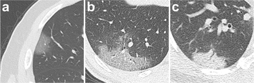 Chest CT findings of COVID-19 pneumonia on transaxial images. #coronavirus #nCoV2019 #2019nCoV #COVID19