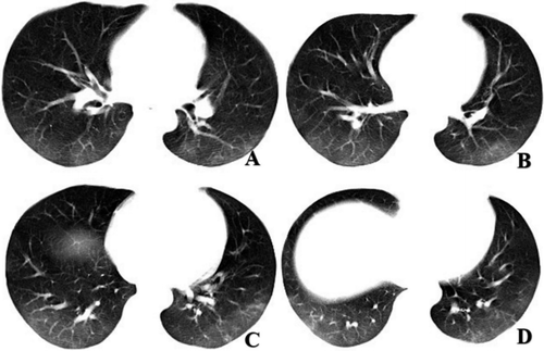 CT images showed bilateral subpleural bandlike areas of GGO compatible with viral pneumonia. #coronavirus #nCoV2019 #2019nCoV #COVID19