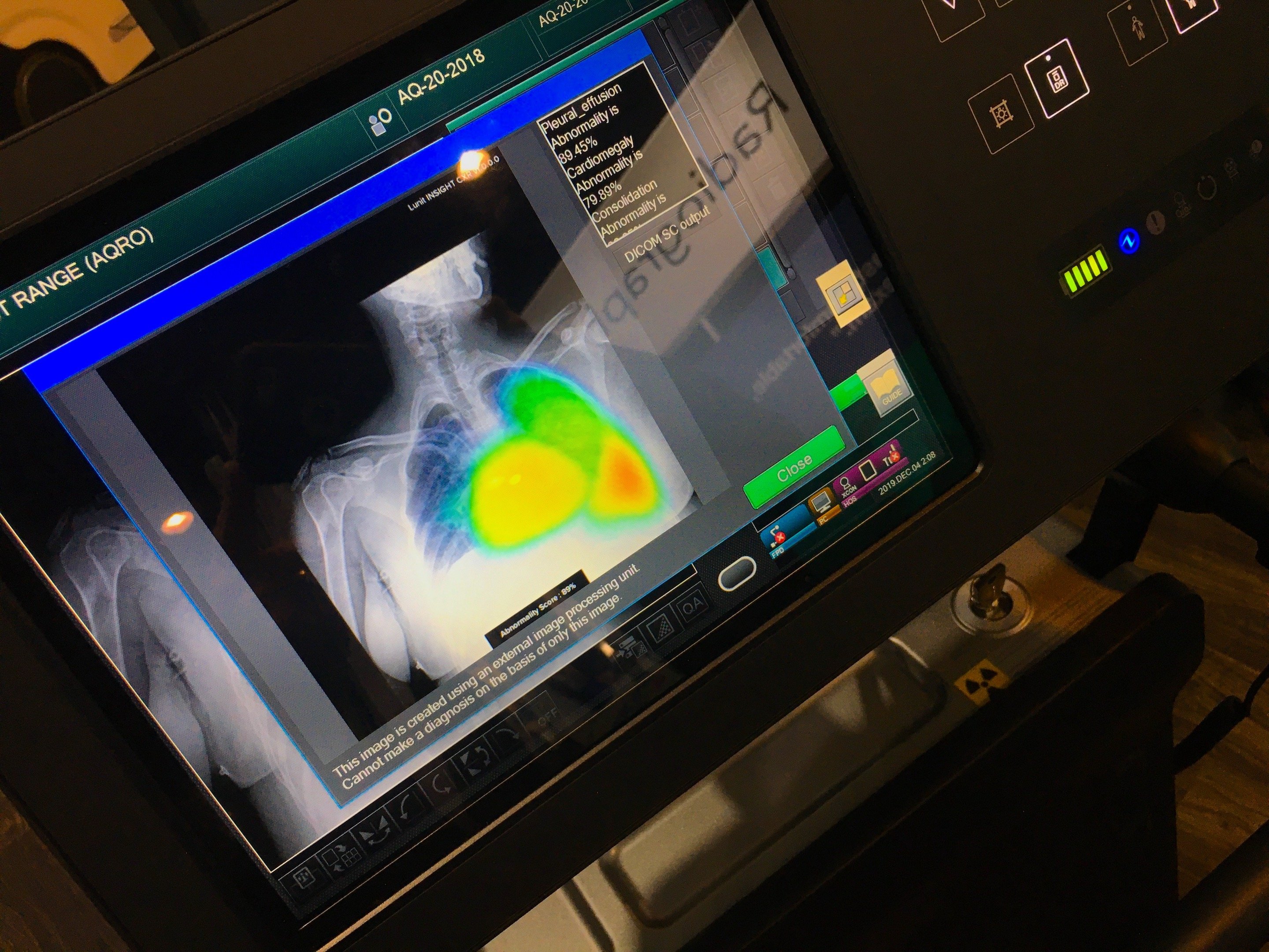 This is an artificial intelligence (AI) application from Lunit that automatically detects a collapsed lung (pneumothorax) on a Fujifilm mobile DR X-ray system. The AI automaticially scans all images as they are captured to determine if there is a critical finding and if so, immediately alerts the RT so it can be listed as a STAT read and so they cal alert the attending physician. Photo by Dave Fornell. #RSNA