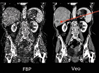 liver metastasis, iterative reconstruction