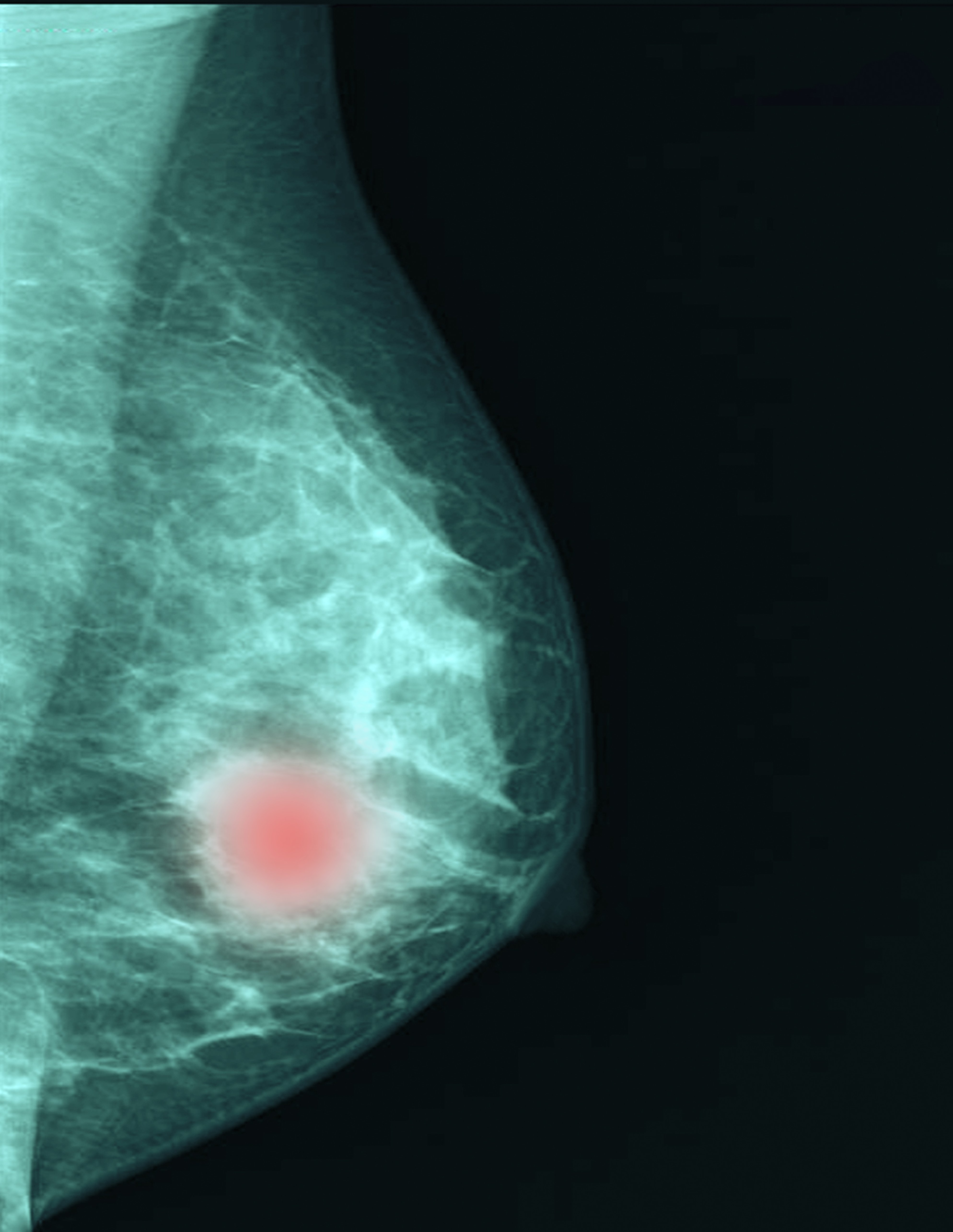 AI has the potential to help radiologists improve the efficiency and effectiveness of breast cancer imaging