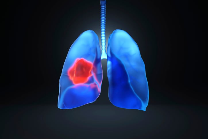 The industry is seeing a sense of momentum from industry leaders to help expand lung screening programs