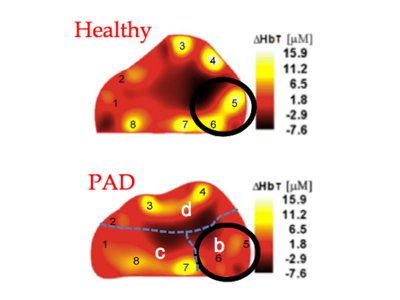 Hielscher, Columbia, PAD, OCT, diabetes, optical tomographic imaging, peripheral