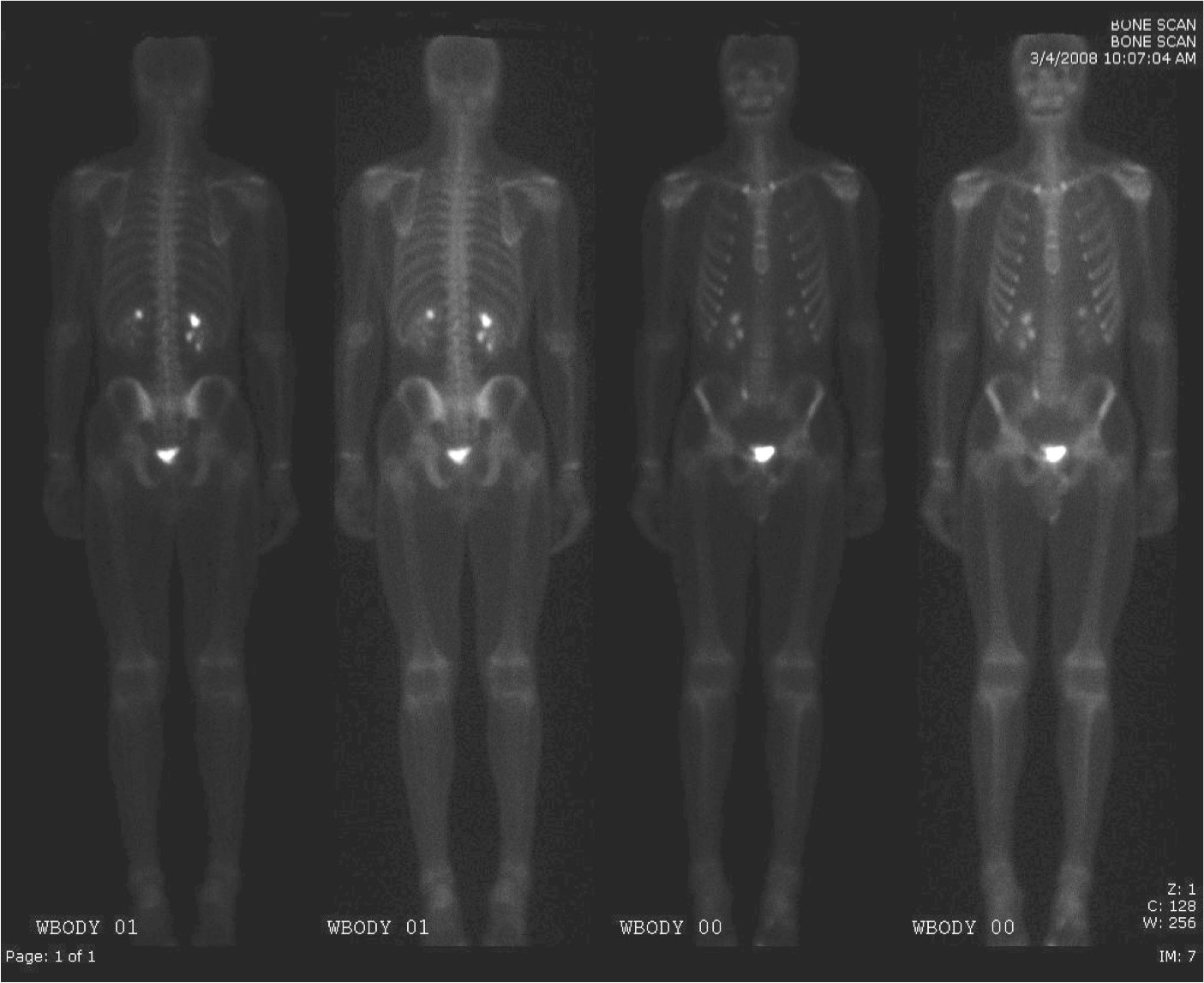 non-Hodgkins lymphoma, PET/CT, recurrence, SNMMI 2015