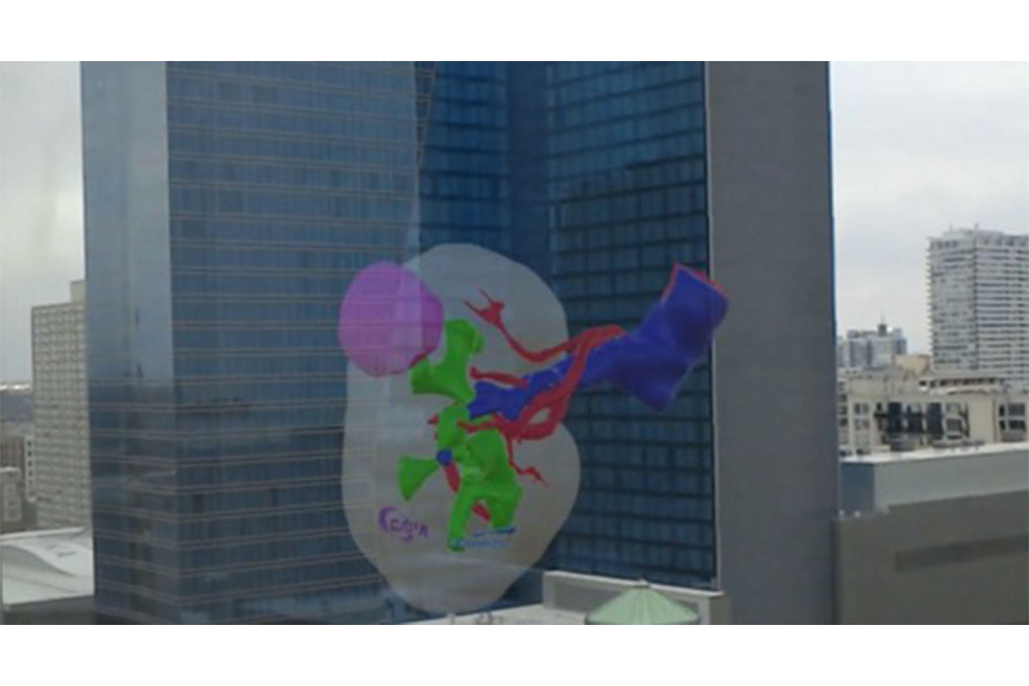 A 3-D printed model (left) and a model constructed in augmented reality (right), both of a kidney with a tumor. In both models, the kidney is clear; the tumor is visible in purple on the AR model and in white on the 3-D printed model.