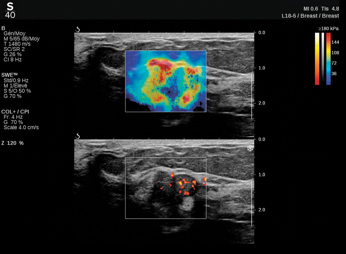 This is an example of 3-D ultrasound imaging on a breast, designed to help increase efficiency and diagnostic accuracy in any practice. Image courtesy of Hologic.