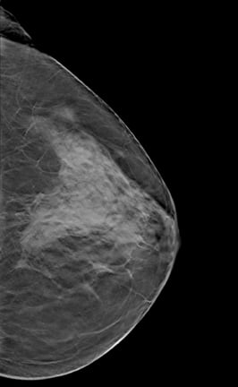 dense breast tissue shown by an ultrasound of breast 