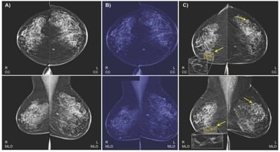 IBM collected a dataset of 52,936 images from 13,234 women who underwent at least one mammogram between 2013 and 2017.