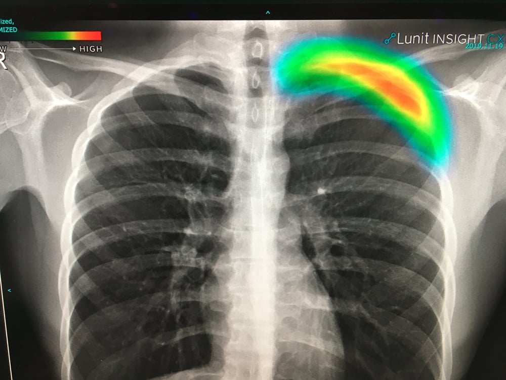 This is a lung X-ray reviewed automatically by artificial intelligence (AI) to identify a collapsed lung (pneumothorax) in the color coded area. This AI app from Lunit is awaiting final FDA review and in planned to be integrated into several vendors' mobile digital radiography (DR) systems. Fujifilm showed this software integrated as a work-in-progress into its mobile X-ray system at RSNA 2019. GE Healthcare has its own version of this software for its mobile r=ray systems that gained FDA in 2019.   #RSNA #