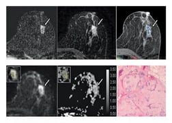 Diffusion-Weighted  Imaging to Reduce Breast MRI  False Positives
