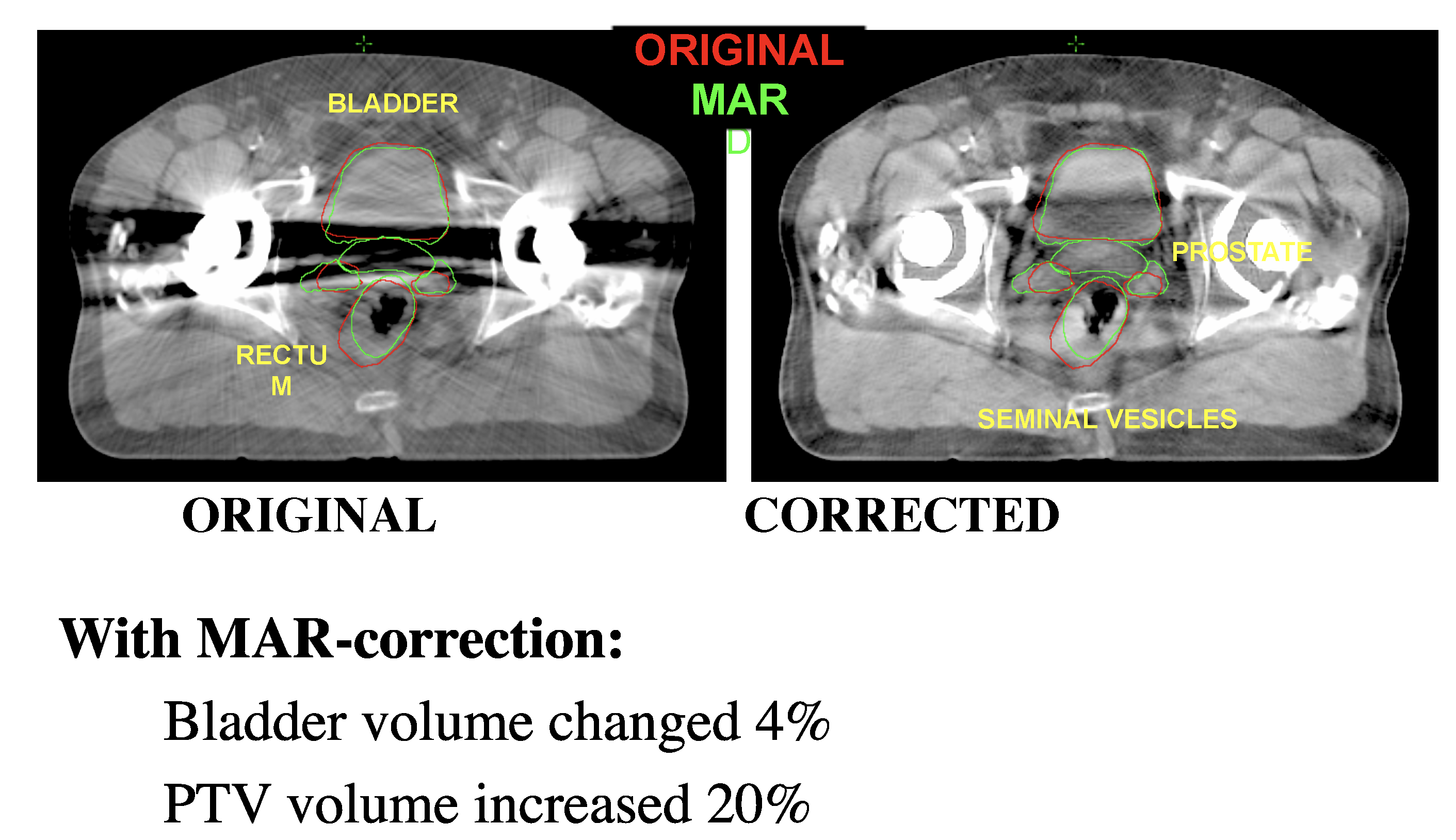 Metal artifact reduction led to a 20 percent increase in the planning target volume (PTV) in this prostate cancer case from Henry Ford Health System. The volume of the healthy bladder tissue to be spared was also reduced by 4 percent. 