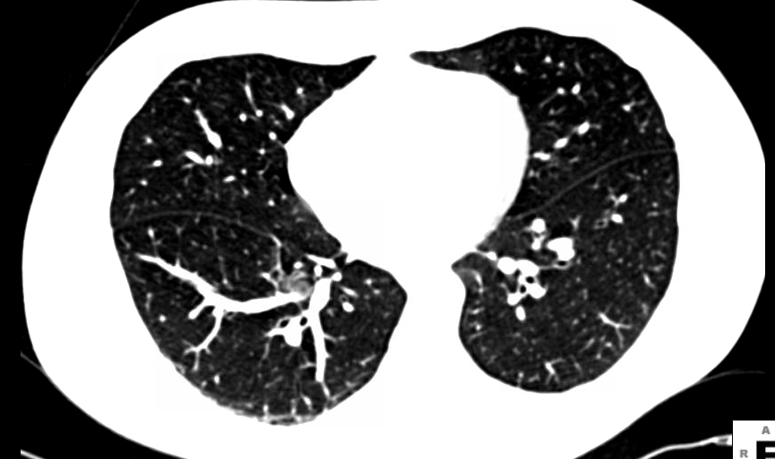 American College of Radiology Designated Lung Cancer Screening Center Program