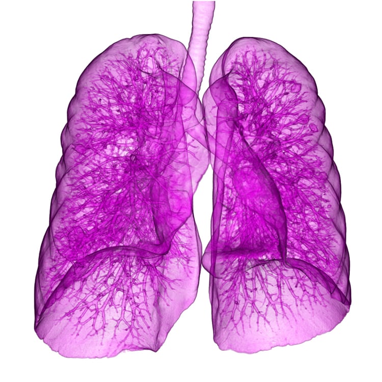 This image, taken with Canon's Aquilion One, shows a lung with metastases from bowel cancer.