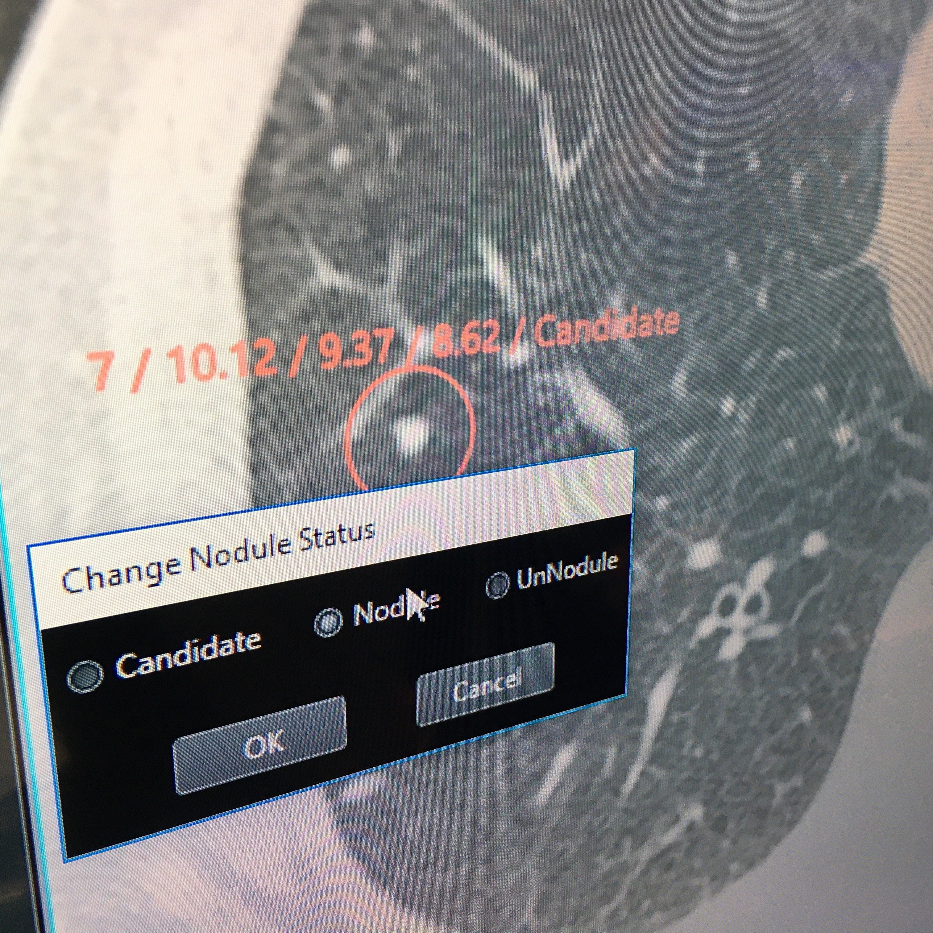 An example of artificial intelligence (AI) being developed by Hitachi to automatically review and identify nodules on lung CT scans. This is part of a suite of AI apps Hitachi is developing. This example was being shown as a work in progress at RSNA 2019.