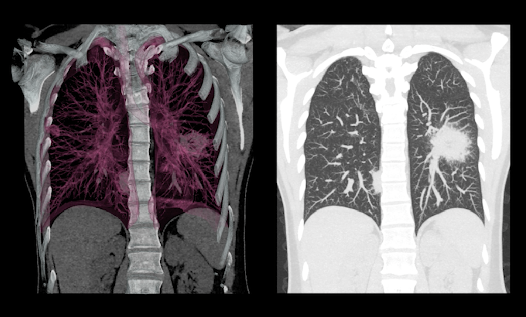 A low-dose lung CT scan can be used to help detect mesothelioma. 