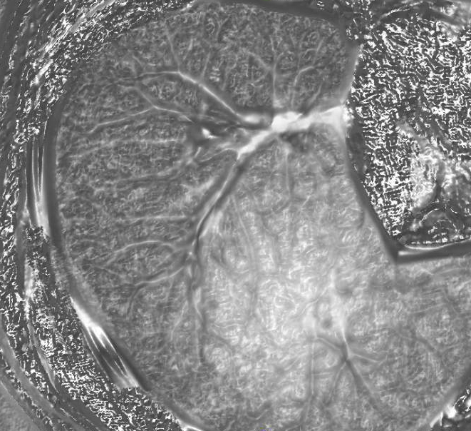 COPD, emphysema, MRI, CT, FEV1, treatment, Robarts, Grace Parraga