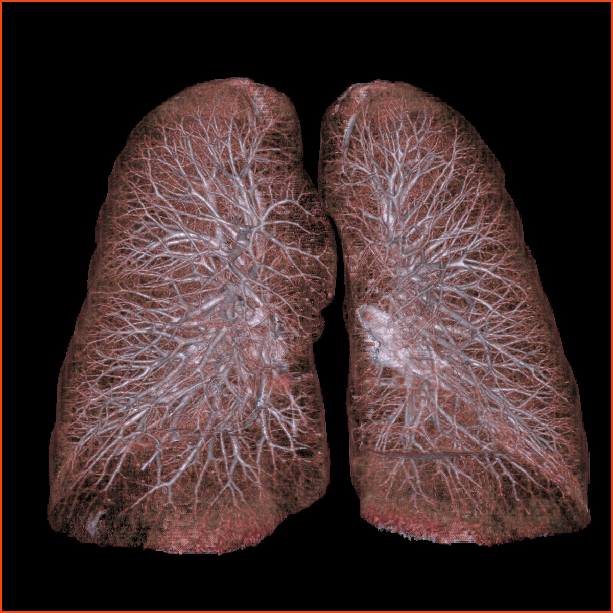 U.S. Preventive Services Task Force \"B\" Rating Lung CT At Risk Patients