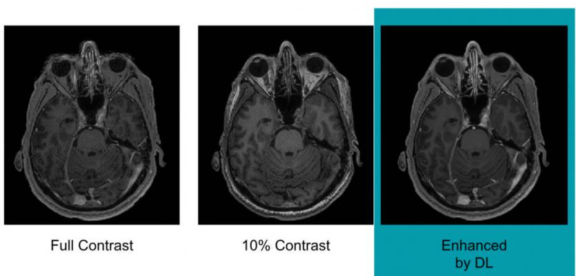 Example of full-dose, 10 percent low-dose and algorithm-enhanced low-dose. Image courtesy of Enhao Gong, Ph.D.